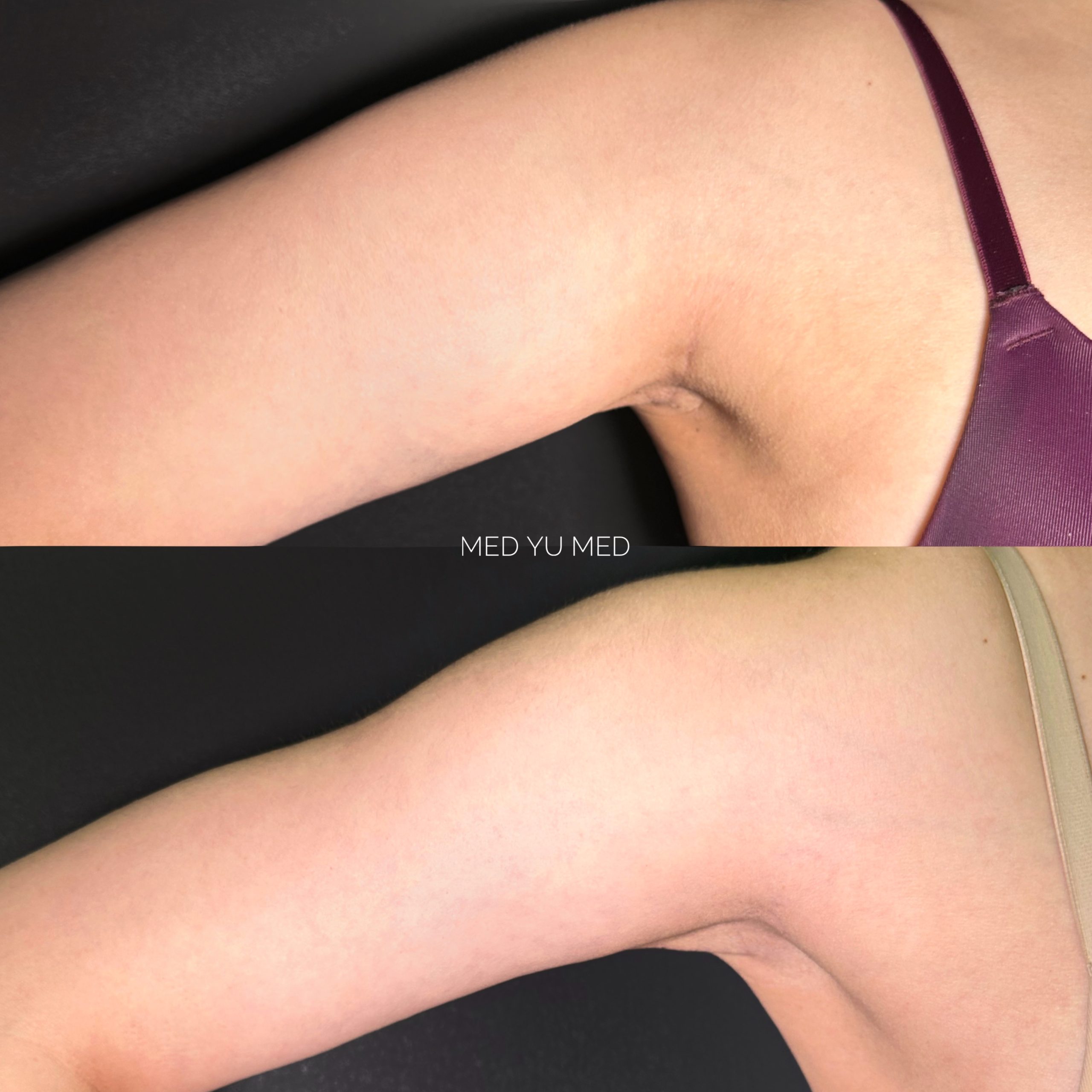 Before and after Lipolytic (Fat-Dissolving) Injections at MED YU MED Dubai: underarm and upper arm, localised fat