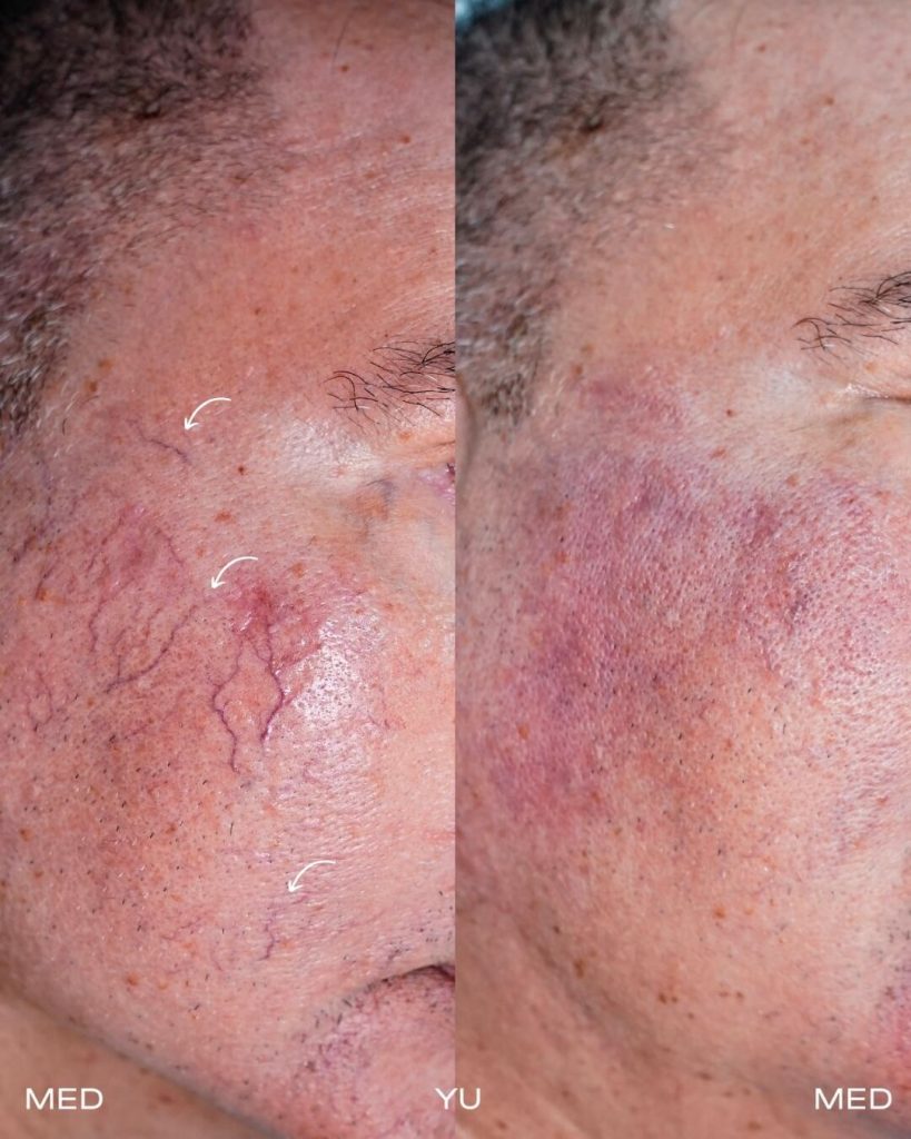 Before and after Fotona Laser at MED YU MED Dubai: cheek, spider veins