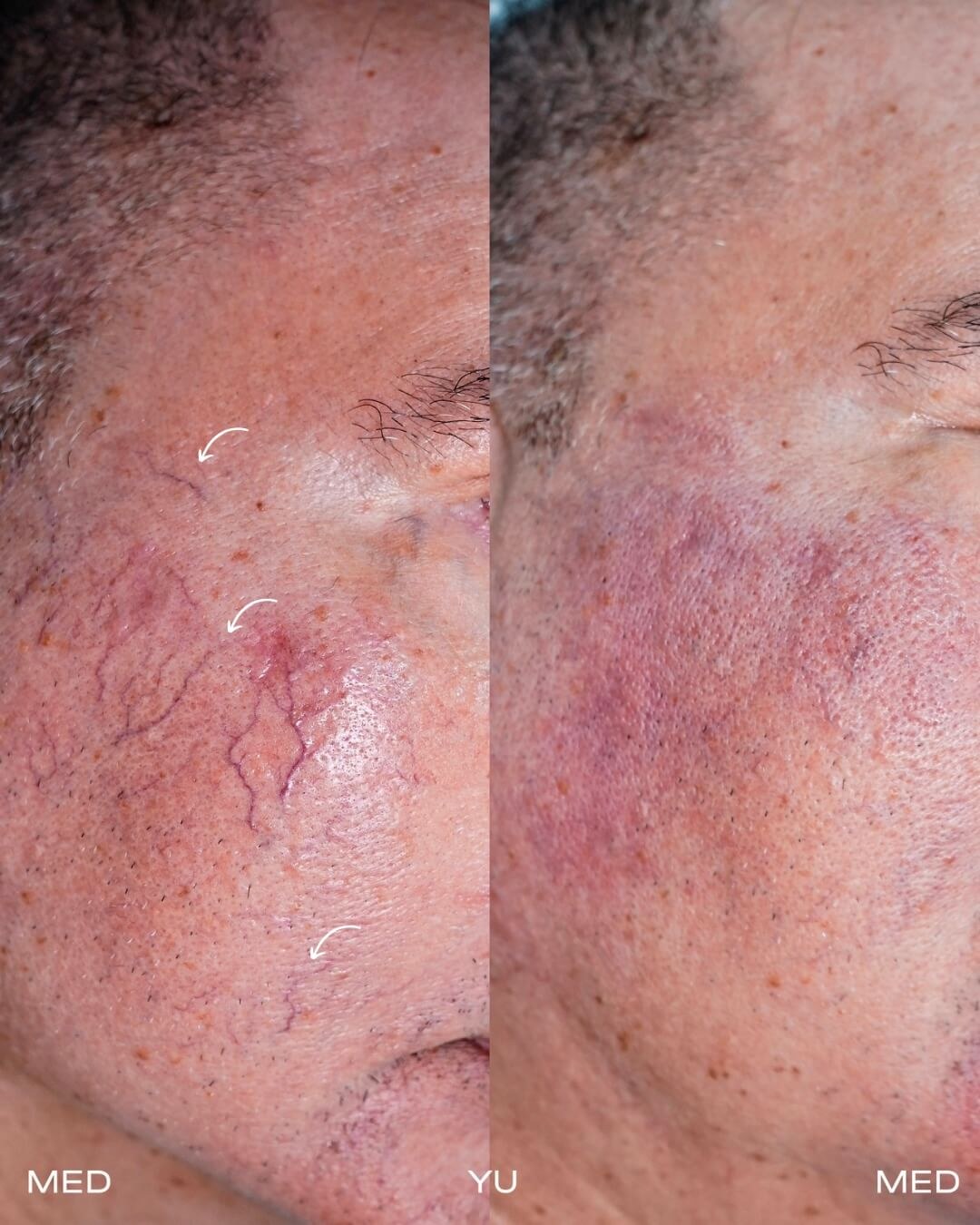 Before and after Fotona Laser at MED YU MED Dubai: cheek, spider veins