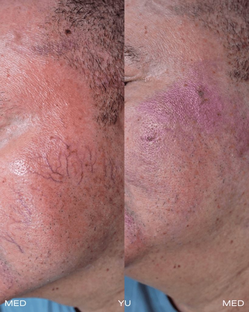 Before and after Fotona Laser at MED YU MED Dubai: cheek and temple, spider veins
