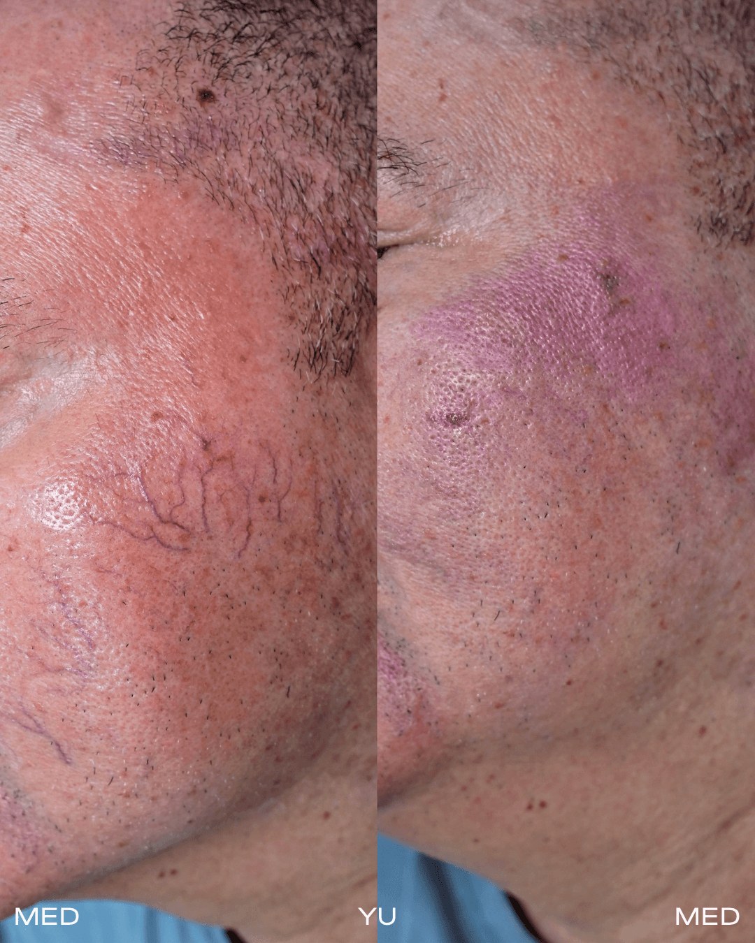 Before and after Fotona Laser at MED YU MED Dubai: cheek and temple, spider veins
